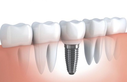 Trồng răng sứ bị đen chân răng - Do cách chăm sóc hay vật liệu trồng răng-2
