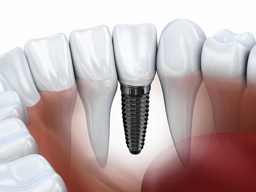 Trồng răng sứ bị đen chân răng - Do cách chăm sóc hay vật liệu trồng răng-3 Trồng răng sứ bị đen chân răng - Do cách chăm sóc hay vật liệu trồng răng-3