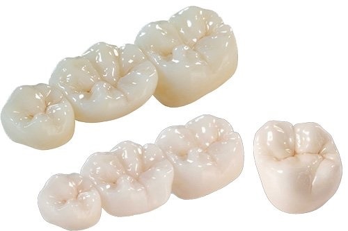 Trồng răng sứ bị đen chân răng - Do cách chăm sóc hay vật liệu trồng răng-4