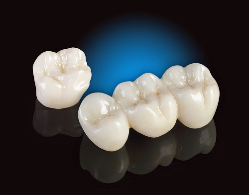 Trồng răng sứ dùng được bao lâu? Những lưu ý duy trì độ bền răng sứ-3 Trồng răng sứ dùng được bao lâu? Những lưu ý duy trì độ bền răng sứ-3