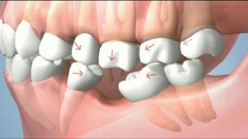 Trồng răng cấm hết bao nhiêu tiền? Mức chi phí phù hợp 1
