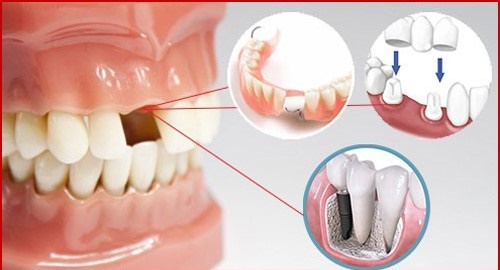 Trồng răng có chân răng với phương pháp nào? 1 Trồng răng có chân răng với phương pháp nào? 1
