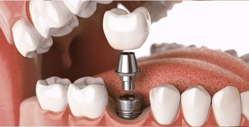 Trồng răng có chân răng với phương pháp nào? 2