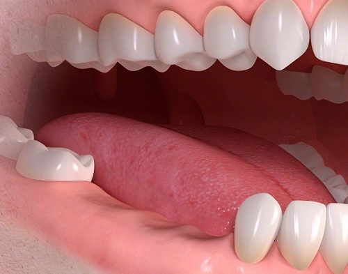 Trồng răng cối bằng phương pháp implant hiệu quả cao 1 Trồng răng cối bằng phương pháp implant hiệu quả cao 1