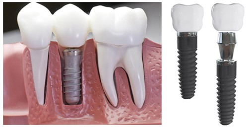 Trồng răng cối bằng phương pháp implant hiệu quả cao 2