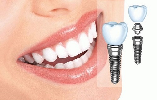 Trồng răng cối bằng phương pháp implant hiệu quả cao 3
