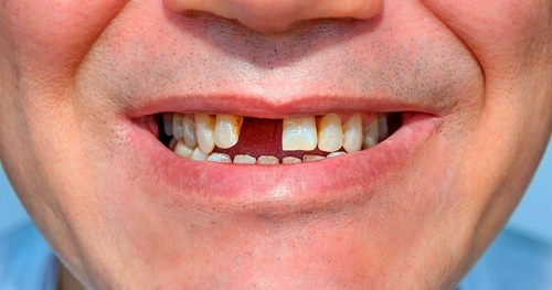 Trồng răng giả có đau không? Kiến thức cần biết khi trồng răng 1 Trồng răng giả có đau không? Kiến thức cần biết khi trồng răng 1