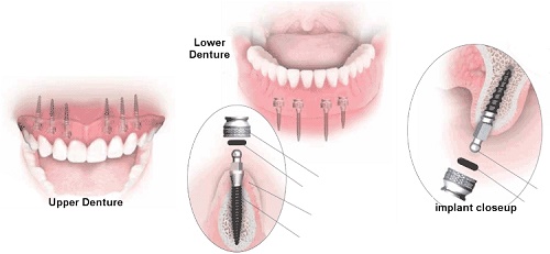 Trồng răng giả có đau không? Kiến thức cần biết khi trồng răng 3 Trồng răng giả có đau không? Kiến thức cần biết khi trồng răng 3