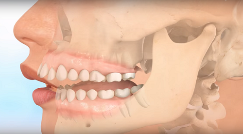 Răng hô nhẹ - Giải pháp khắc phục hiệu quả 1