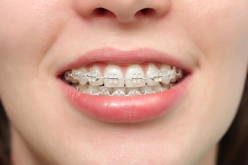 Răng hô nhẹ - Giải pháp khắc phục hiệu quả 3 Răng hô nhẹ - Giải pháp khắc phục hiệu quả 3
