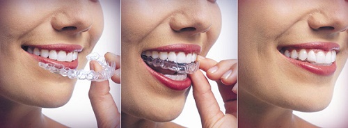 Răng hô nhẹ - Giải pháp khắc phục hiệu quả 5