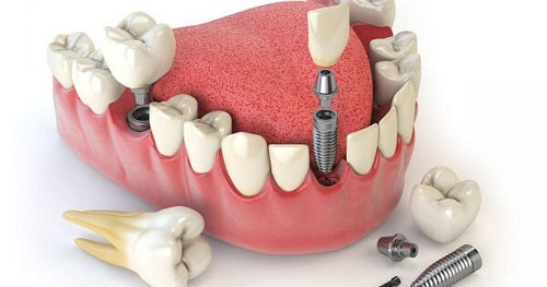 Trồng răng cửa hàm dưới - Phương pháp phục hình 1
