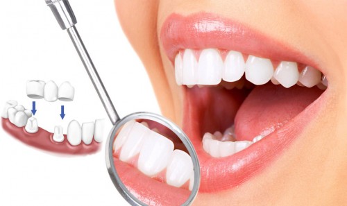 Trồng răng cửa hàm dưới - Phương pháp phục hình 3