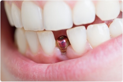 Trồng răng cửa hàm dưới - Phương pháp phục hình 2