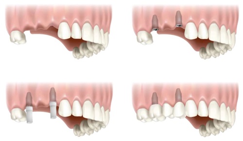 Trồng răng hàm implant giá bao nhiêu tiền? Bảng giá mới 2