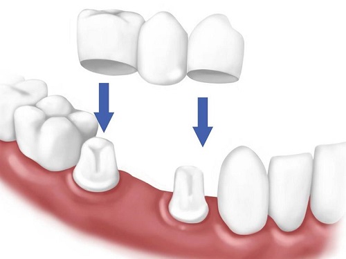 Trồng răng giả có lâu không? Kỹ thuật thực hiện 1 Trồng răng giả có lâu không? Kỹ thuật thực hiện 1