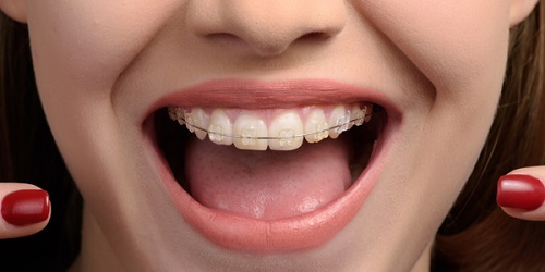 Niềng răng lệch nhân trung - Nguyên nhân và cách xử lý 2