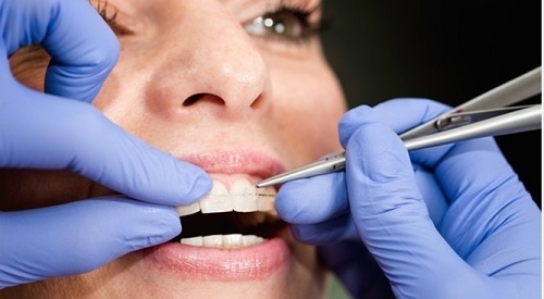 Niềng răng lệch nhân trung - Nguyên nhân và cách xử lý 3