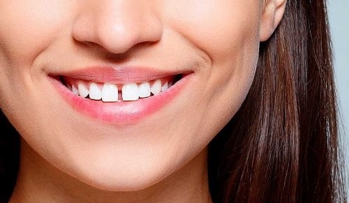 Kinh nghiệm niềng răng thưa hữu ích nhất cho bạn 1 Kinh nghiệm niềng răng thưa hữu ích nhất cho bạn 1