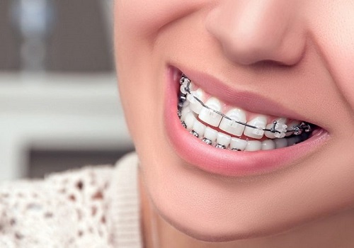 Kinh nghiệm niềng răng thưa hữu ích nhất cho bạn 2 Kinh nghiệm niềng răng thưa hữu ích nhất cho bạn 2