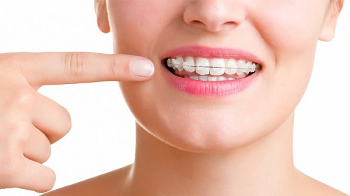 Niềng răng mắc cài sứ có đau không? Thông tin thực tế từ nha khoa 1