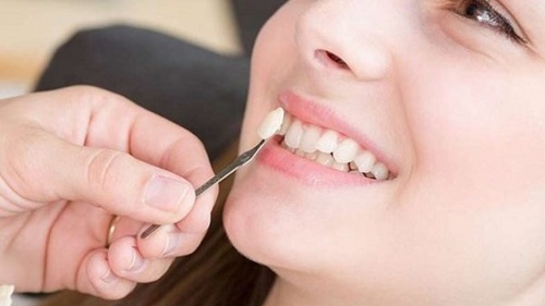 Trồng răng khểnh có đau không? Có nên trồng răng khểnh 1