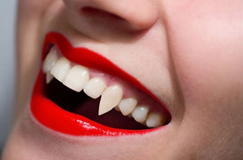 Trồng răng khểnh có đau không? Có nên trồng răng khểnh 2
