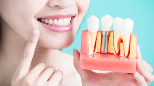 Quá trình trồng răng kiêng ăn gì để đảm bảo kết quả? 1