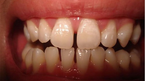 Niềng răng ăn cháo bao lâu là được? 2 Niềng răng ăn cháo bao lâu là được? 2