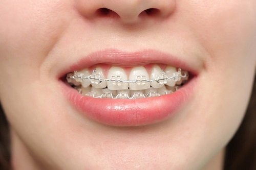 Niềng răng làm răng lung lay gây ảnh hưởng gì không? 1