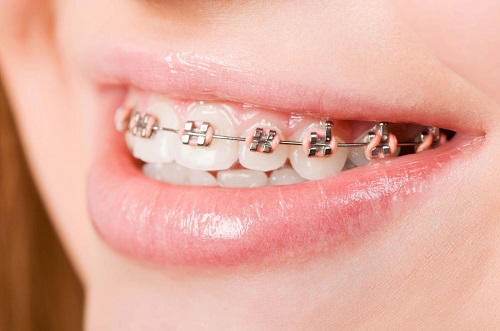 Niềng răng làm răng lung lay gây ảnh hưởng gì không? 2