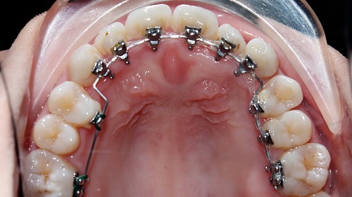 Niềng răng mặt trong có đau không? Cần lưu ý điểm gì khi niềng răng? 2