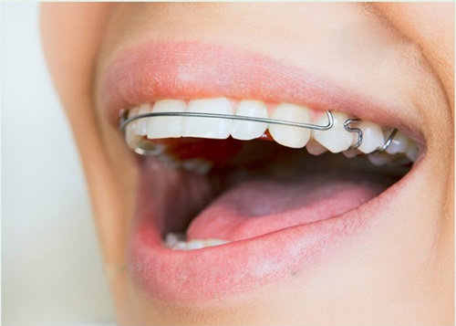 Niềng răng phải đeo hàm duy trì bao lâu là được? 2