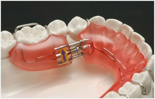 Niềng răng phải đeo hàm duy trì bao lâu là được? 3