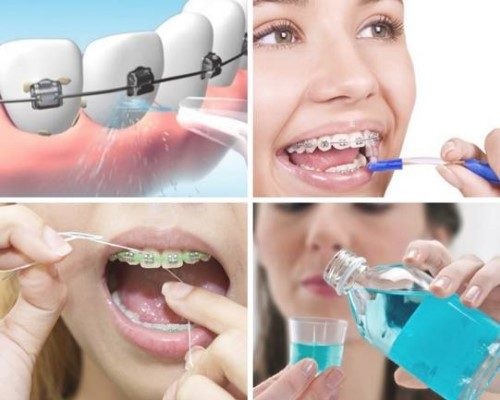 Niềng răng nên dùng bàn chải gì để thực hiện vệ sinh hiệu quả? 2