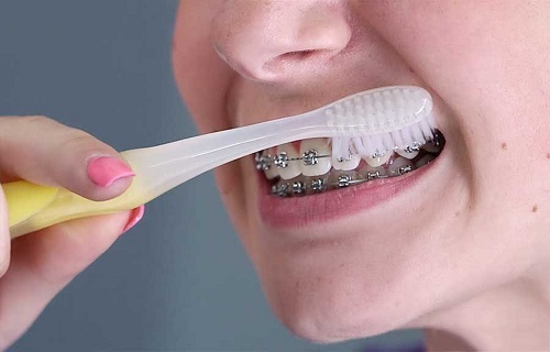 Niềng răng nên dùng bàn chải gì để thực hiện vệ sinh hiệu quả? 3