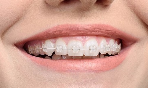 Niềng răng bị viêm lợi - Nguyên nhân - Hậu quả - Cách xử lý *