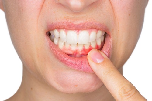 Nguyên nhân niềng răng bị viêm lợi *