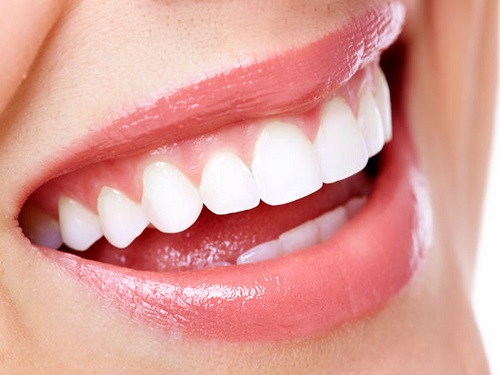 Cách xử lý hiệu quả niềng răng bị viêm lợi *