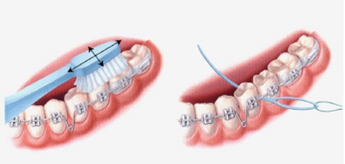 Niềng răng nên ăn gì giúp vệ sinh răng miệng tốt hơn? 2 Niềng răng nên ăn gì giúp vệ sinh răng miệng tốt hơn? 2
