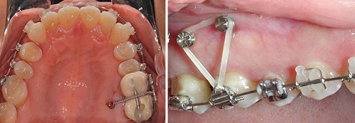 Cắm vít niềng răng có đau không? Tìm hiểu 2 Cắm vít niềng răng có đau không? Tìm hiểu 2