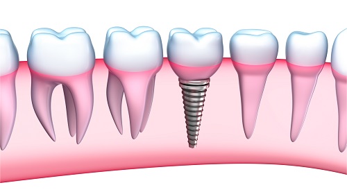 Kinh nghiệm làm răng implant cho người bị mất răng 2