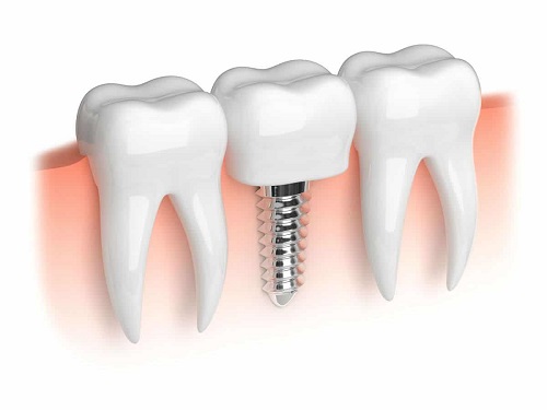 Kinh nghiệm làm răng implant cho người bị mất răng 3 Kinh nghiệm làm răng implant cho người bị mất răng 3