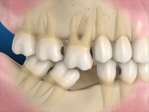 Mất răng lâu năm có trồng được không? Giải pháp khắc phục 1 Mất răng lâu năm có trồng được không? Giải pháp khắc phục 1