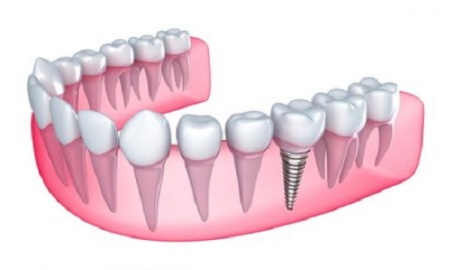 Trồng răng sứ có bền không? Lời khuyên từ nha khoa 1 Trồng răng sứ có bền không? Lời khuyên từ nha khoa 1