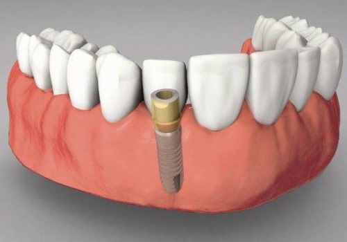 Trồng răng sứ có bền không? Lời khuyên từ nha khoa 3 Trồng răng sứ có bền không? Lời khuyên từ nha khoa 3