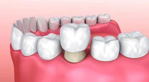 Răng sứ có bị sâu không? Kiến thức nha khoa bạn nên biết 1 Răng sứ có bị sâu không? Kiến thức nha khoa bạn nên biết 1