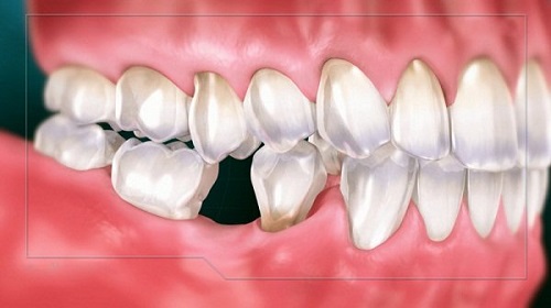 Trồng răng nên ăn gì? Thực đơn cho người mới trồng răng 1 Trồng răng nên ăn gì? Thực đơn cho người mới trồng răng 1