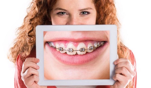 Niềng răng có tốt không? Chuyên gia giải đáp 2 Niềng răng có tốt không? Chuyên gia giải đáp 2