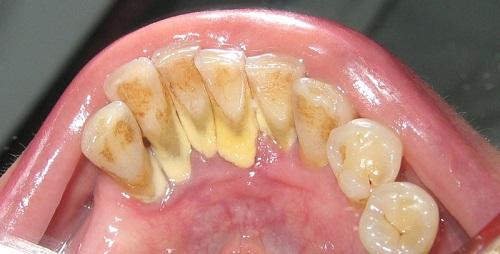 Lấy cao răng có ảnh hưởng không? Nha sĩ tư vấn 1